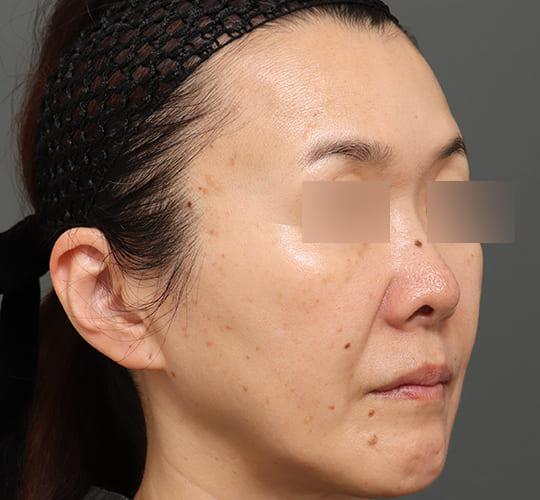 50代女性のアルテミスリフト After 症例写真