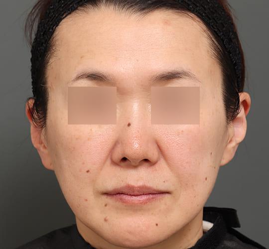 50代女性のヒアルロン酸注射 Before 症例写真