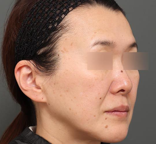 50代女性のアルテミスリフト Before 症例写真