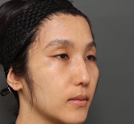 30代男性の額縮小 After 症例写真