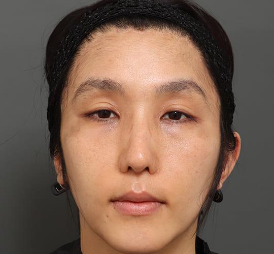 30代男性の額縮小 After 症例写真