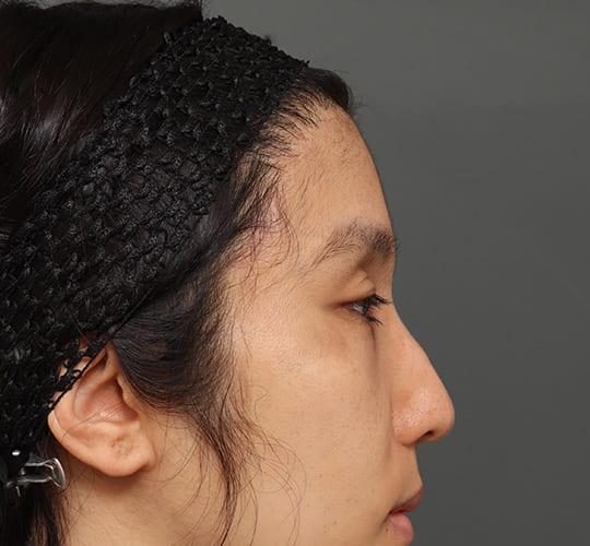 30代男性の額縮小 After 症例写真