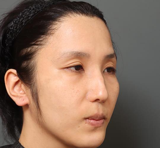 30代男性の額縮小 Before 症例写真