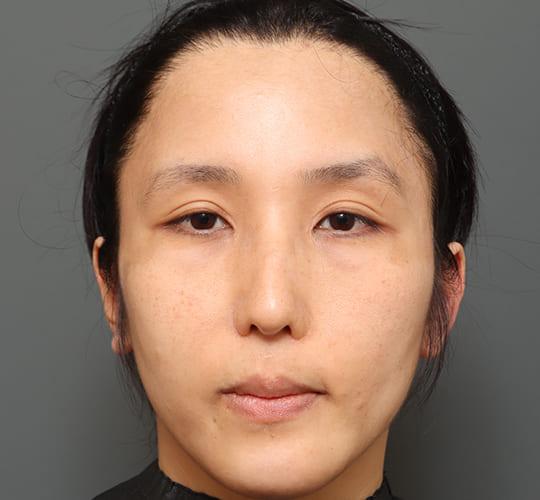 30代男性の額縮小 Before 症例写真