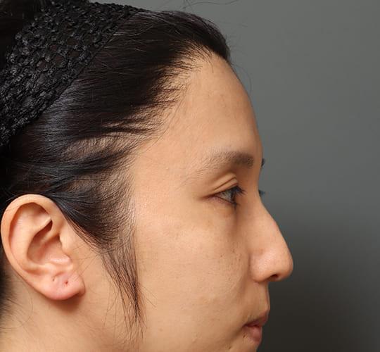 30代男性の額縮小 Before 症例写真