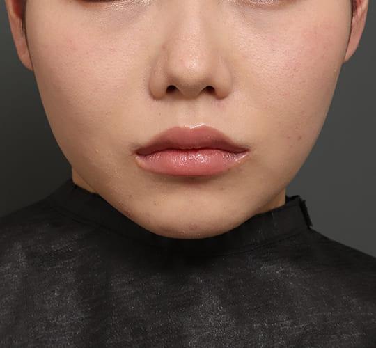 20代女性の口角挙上（スマイルリップ） After 症例写真