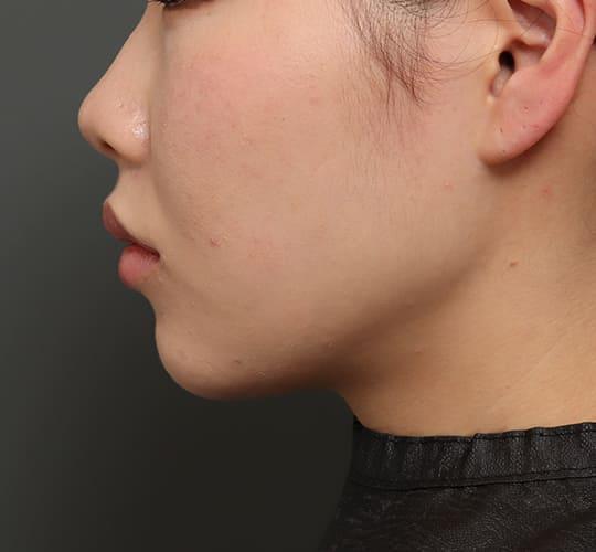 20代女性の口角挙上（スマイルリップ） After 症例写真