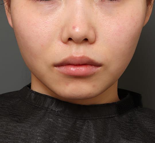 20代女性の口角挙上（スマイルリップ） Before 症例写真