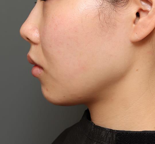 20代女性の口角挙上（スマイルリップ） Before 症例写真