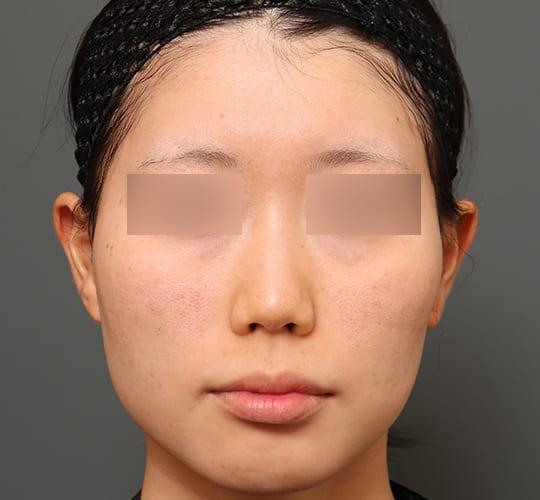 20代女性の顔の脂肪吸引  After 症例写真