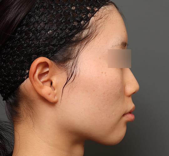 20代女性の顔の脂肪吸引  After 症例写真