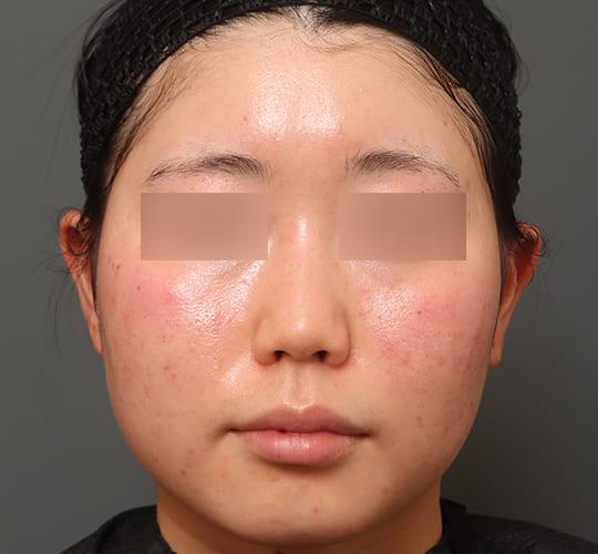 20代女性の顔の脂肪吸引  Before 症例写真