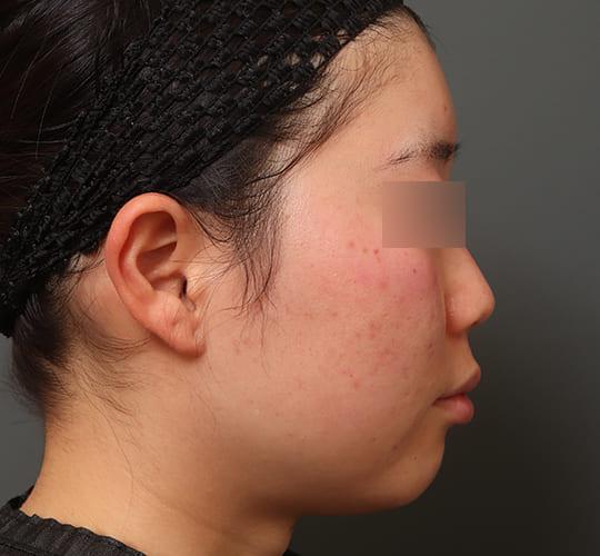 20代女性の顔の脂肪吸引  Before 症例写真