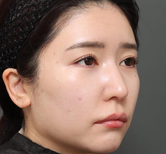 30代女性のミッドフェイスリフト After 症例写真