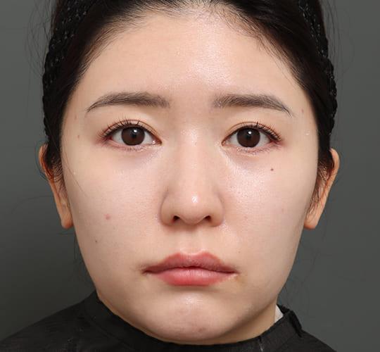30代女性のミッドフェイスリフト After 症例写真