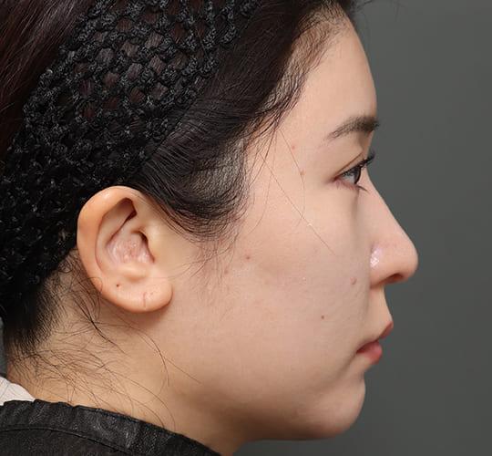 30代女性のミッドフェイスリフト After 症例写真