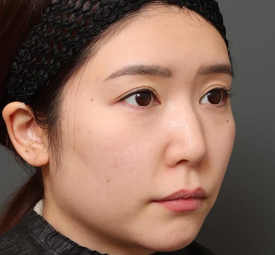 30代女性のミッドフェイスリフト Before 症例写真