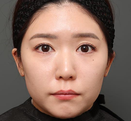 ミッドフェイスリフトでたるみの解消を目指す|【公式】オザキ ミッドフェイスリフトでたるみの解消を目指す|【公式】オザキ