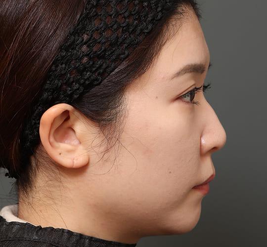 30代女性のミッドフェイスリフト Before 症例写真