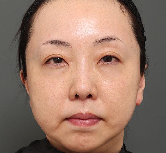 40代女性の人中短縮（リップリフト） After 症例写真