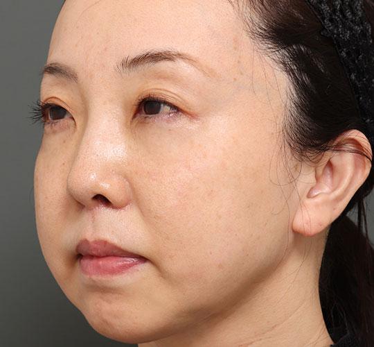 40代女性の人中短縮（リップリフト） After 症例写真