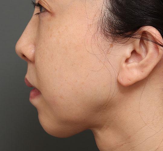 40代女性の人中短縮（リップリフト） After 症例写真