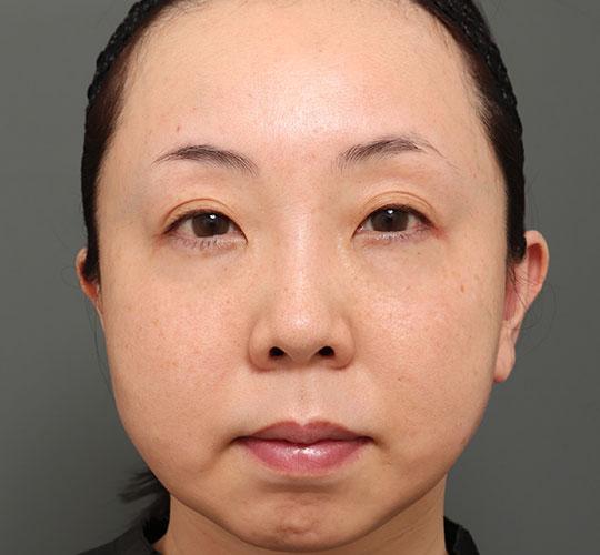 40代女性の人中短縮（リップリフト） Before 症例写真