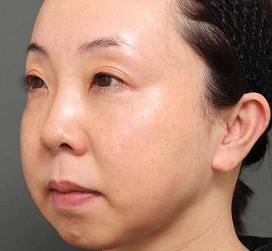 40代女性の人中短縮（リップリフト） Before 症例写真