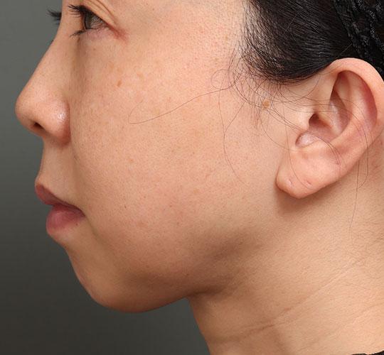 40代女性の人中短縮（リップリフト） Before 症例写真