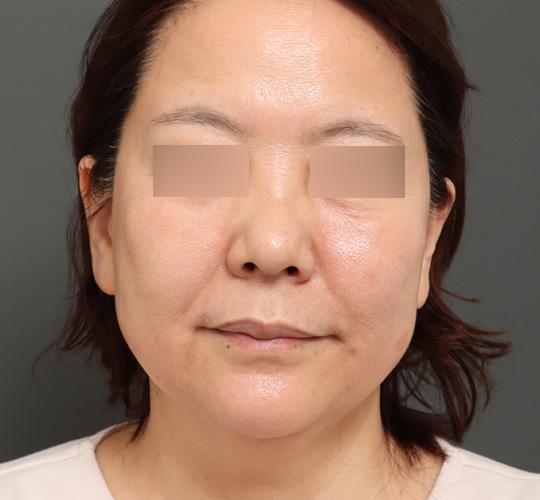 50代女性のボルニューマー After 症例写真