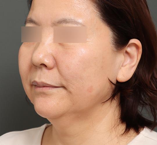 50代女性のボルニューマー After 症例写真