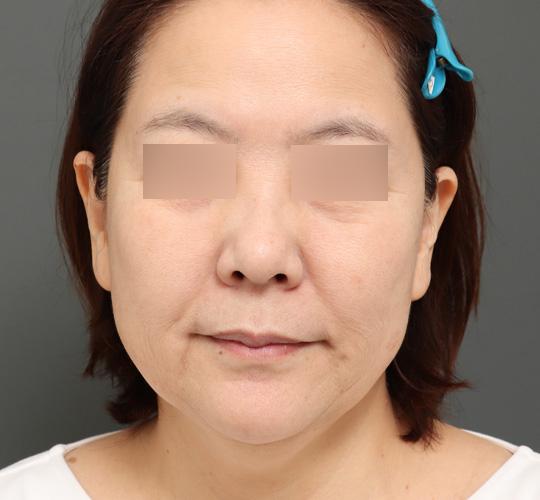 50代女性のボルニューマー Before 症例写真