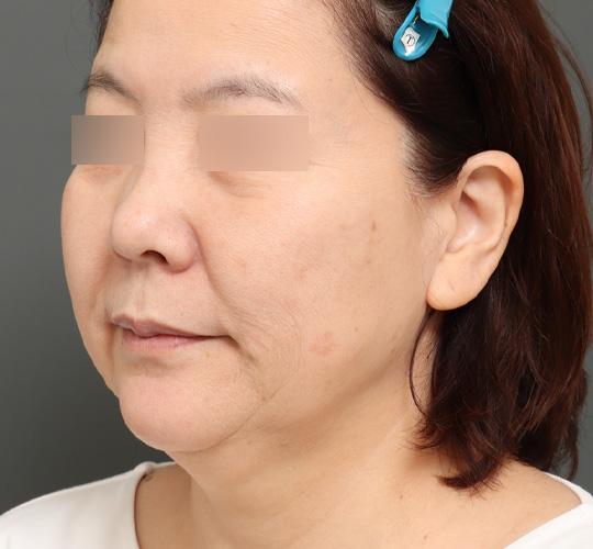 50代女性のボルニューマー Before 症例写真