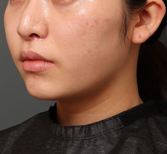 20代女性の人中短縮(リップリフト) After 症例写真