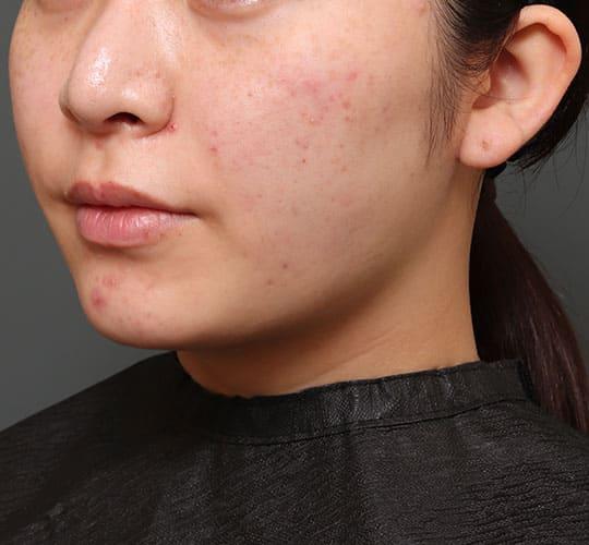 20代女性の人中短縮(リップリフト) Before 症例写真