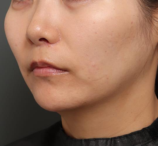 30代女性の人中短縮（リップリフト） After 症例写真