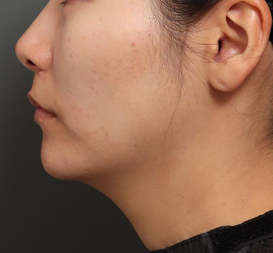 30代女性の人中短縮（リップリフト） After 症例写真