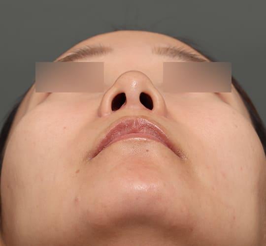 30代女性の人中短縮（リップリフト） After 症例写真