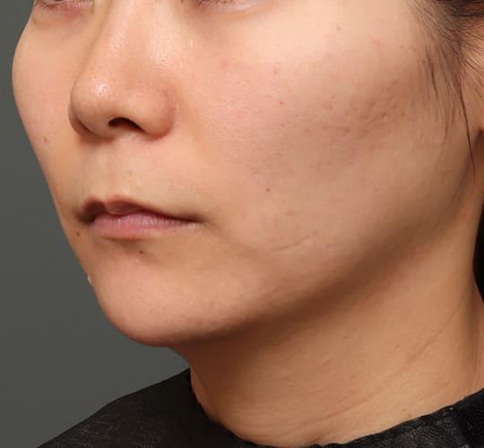 30代女性の人中短縮（リップリフト） Before 症例写真