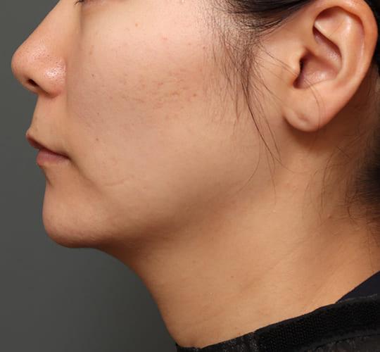 30代女性の人中短縮（リップリフト） Before 症例写真