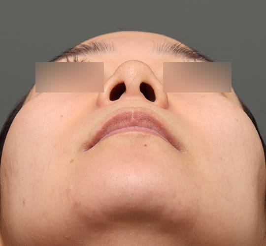 30代女性の人中短縮（リップリフト） Before 症例写真