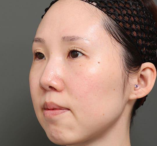 30代女性の人中短縮(リップリフト) After 症例写真