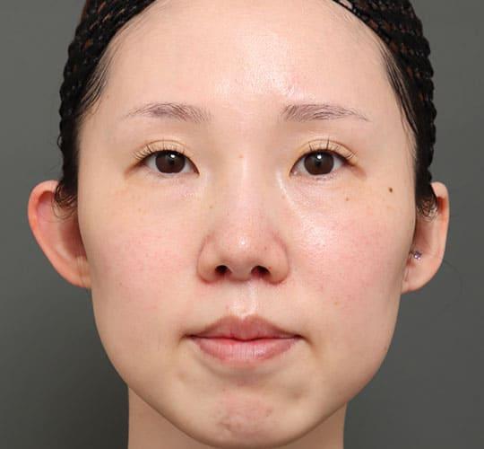 30代女性の人中短縮(リップリフト) After 症例写真