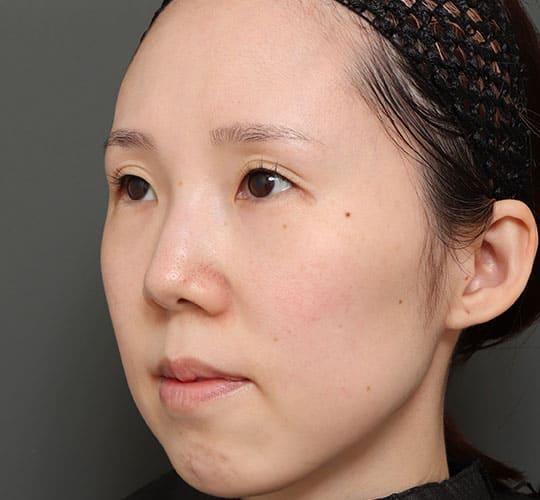 30代女性の人中短縮(リップリフト) Before 症例写真