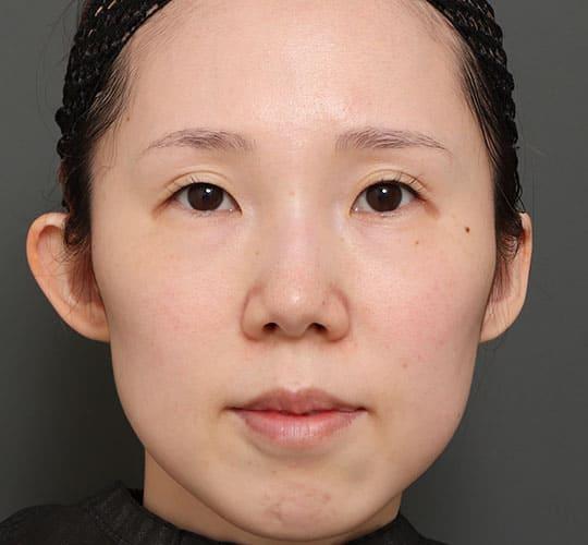 30代女性の人中短縮(リップリフト) Before 症例写真
