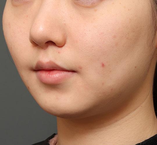 20代女性の人中短縮（リップリフト） After 症例写真