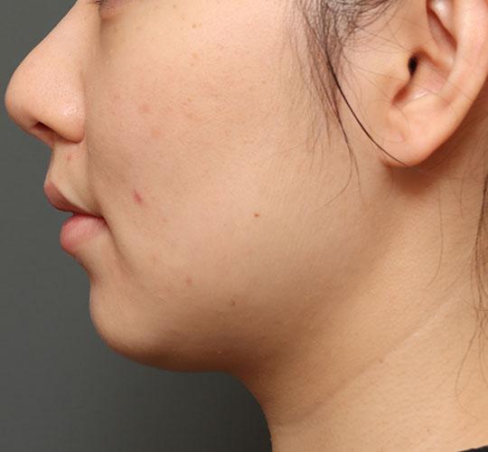 20代女性の人中短縮（リップリフト） After 症例写真