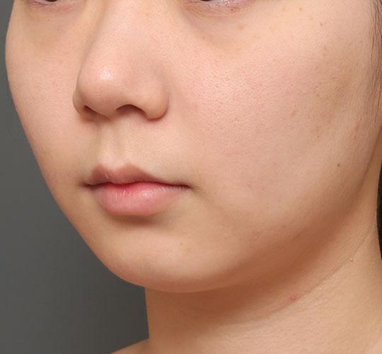 20代女性の人中短縮（リップリフト） Before 症例写真