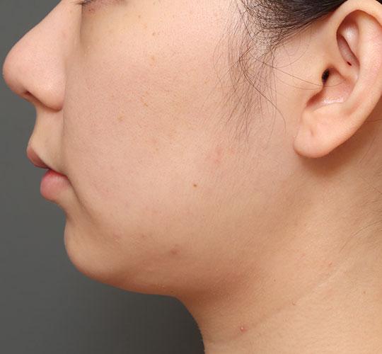 20代女性の人中短縮（リップリフト） Before 症例写真