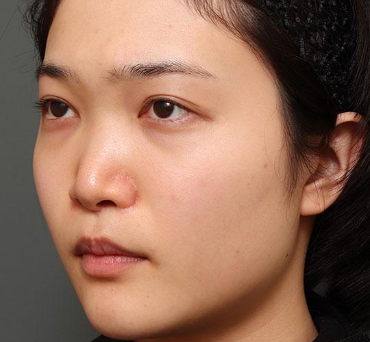 20代女性の人中短縮（リップリフト） After 症例写真